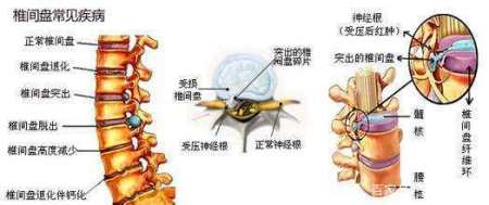 腰椎间盘突出压迫神经腿疼，科学治疗与日常管理指南